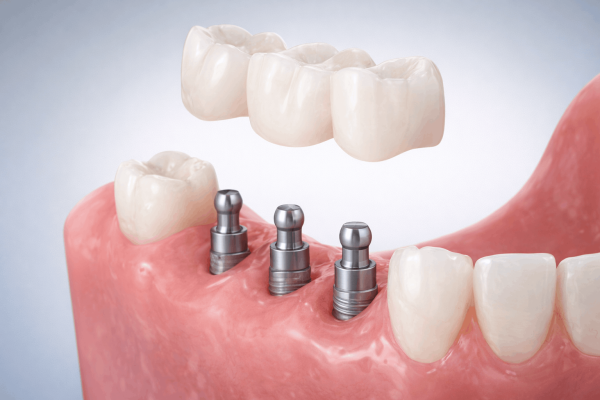 Мини импланты MDI (Mini Dental Implants)