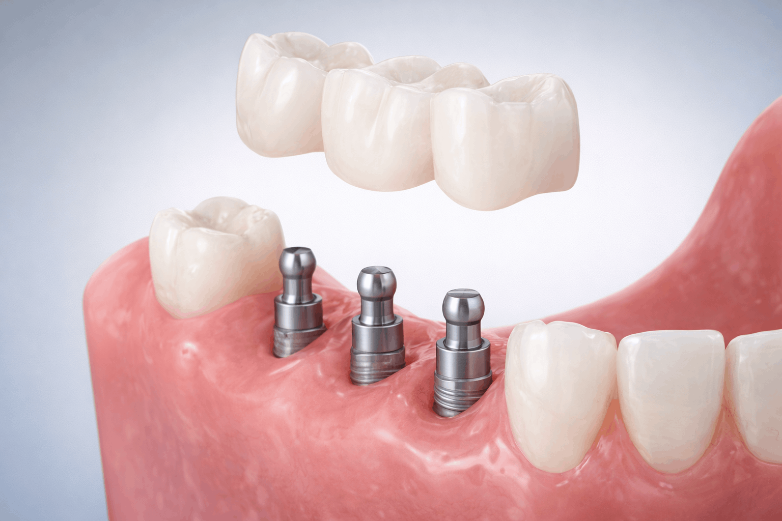 Мини импланты MDI (Mini Dental Implants) в Москве в стоматологии Аполлония Стом